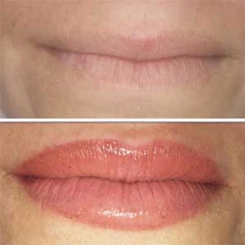 Aumento-labios-micropigmentación-delineado-efecto-volumen-mia-spa-lima